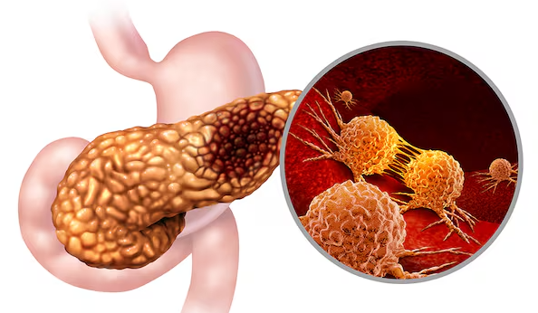 전 세계 암 사망률 3위 췌장암 피 한 방울로 초기에 잡는다